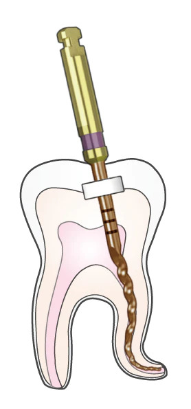 Woodpecker Endo Plus Heat Treated Gold Rotary Files - Image 3